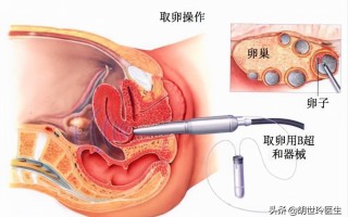 试管婴儿步骤(试管婴儿步骤取卵疼吗)