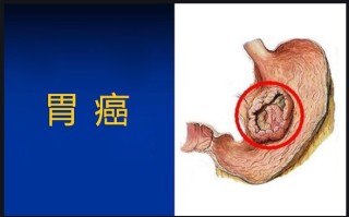 胃癌症状(胃癌症状表现有哪些)