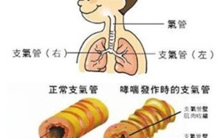 哮喘症状(哮喘症状轻可以不治疗吗)