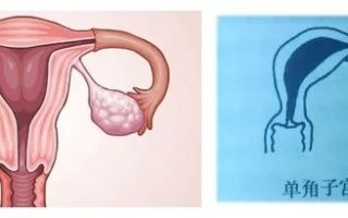 单角子宫试管移植着床攻略(单角子宫试管可以怀双胞胎吗)