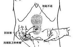 阑尾炎的症状(阑尾炎的症状什么情况下要手术)