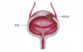 膀胱癌(膀胱癌发现血尿还能活多久)