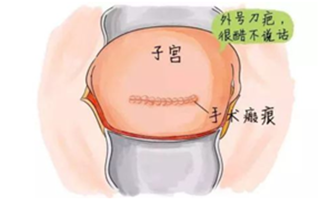 剖腹产三胎十年后可以要四胎吗(剖腹产3胎了,还可以再要孩子吗)