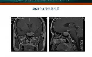 垂体瘤术后试管婴儿怎么做(垂体瘤术后影响怀孕吗的短视频)