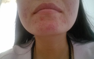 中医认为婴儿长痤疮原因(新生儿痤疮中药熬来怎么洗)