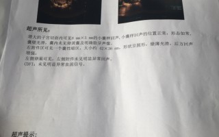 试管婴儿侧脑室增宽是什么引起的啊什么原因的简单介绍