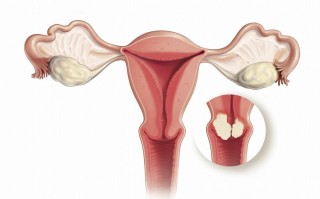 宫颈病(宫颈病变的早期症状图片)