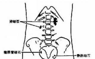 肾结石病因(肾结石病因是什么)