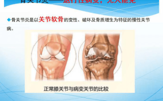 骨关节炎(骨关节炎是什么原因引起的)