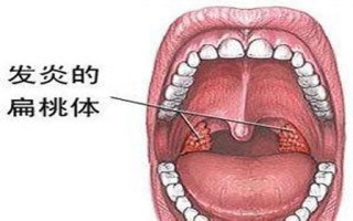 宝宝喉咙发炎饮食需注意什么(宝宝喉咙发炎饮食需注意什么呢)