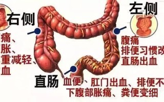 结肠癌的症状(早期结肠癌的症状)