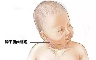 婴儿治疗肌肉斜颈(婴儿治疗肌肉斜颈的方法)