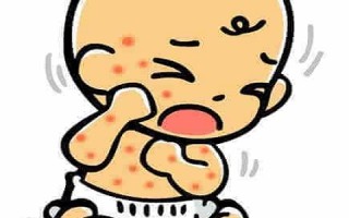 宝宝长湿疹妈妈饮食禁忌(宝宝长湿疹妈妈能吃什么食物)