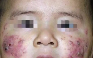 辨别湿疹和婴儿痤疮(婴幼儿湿疹和痤疮的区别)