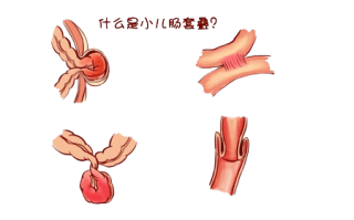 婴儿肠套叠(婴儿肠套叠的三大典型症状是)