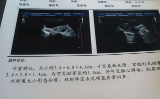 试管移植13天坐车有点颠簸(移植第十二天坐车颠簸了2个小时)