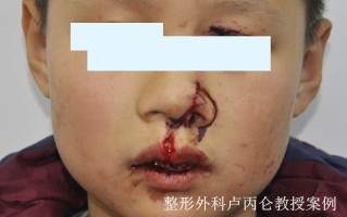 八岁孩子缝针拆线后怎样护理(八岁孩子缝针拆线后怎样护理呢)