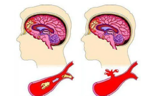 脑梗塞症状(脑梗塞症状有哪些表现)