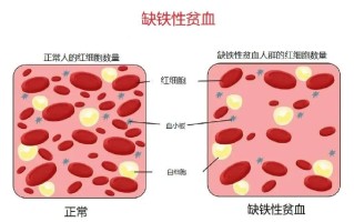 孕妇缺铁性贫血吃什么好(孕妇缺铁性贫血吃什么好呀)